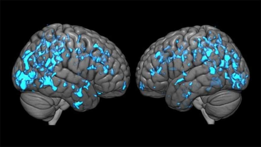 Bad oral bacteria may travel to brain and trigger Parkinson's disease