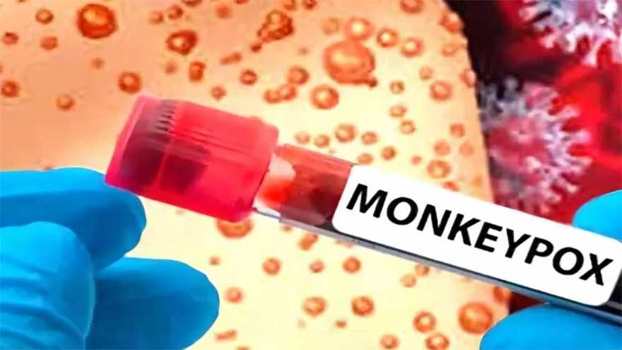 15-year-old boy tests positive for Mpox virus in Lahore