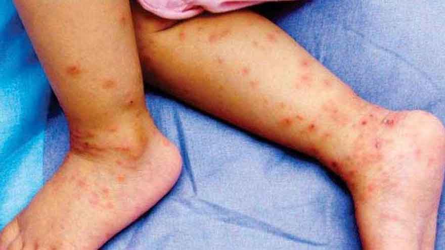 Measles outbreak affects eight children in Kasur village